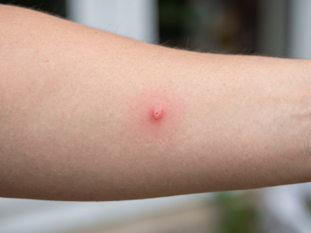 Close-up photo of a fresh horse fly bite showing a raised red welt with mild swelling on human skin, taken a few hours after the bite